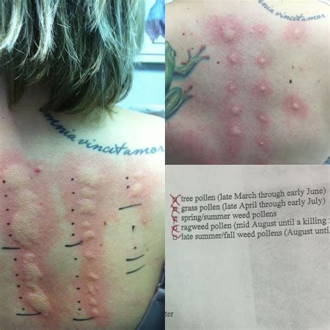 scratch test hives|allergic reaction patch test.